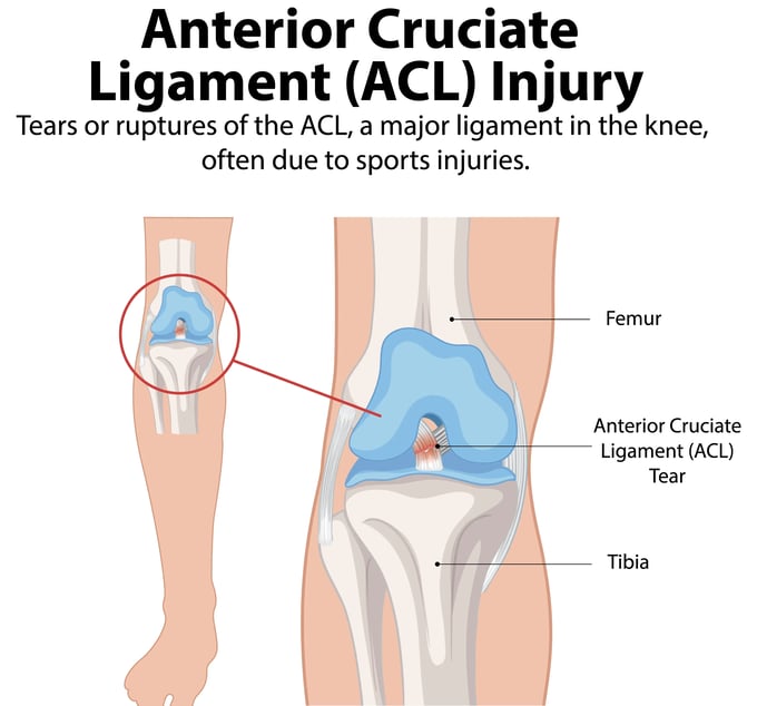 A graphical representation of anterior cruciate ligament Injury showing a tear of the ligament.