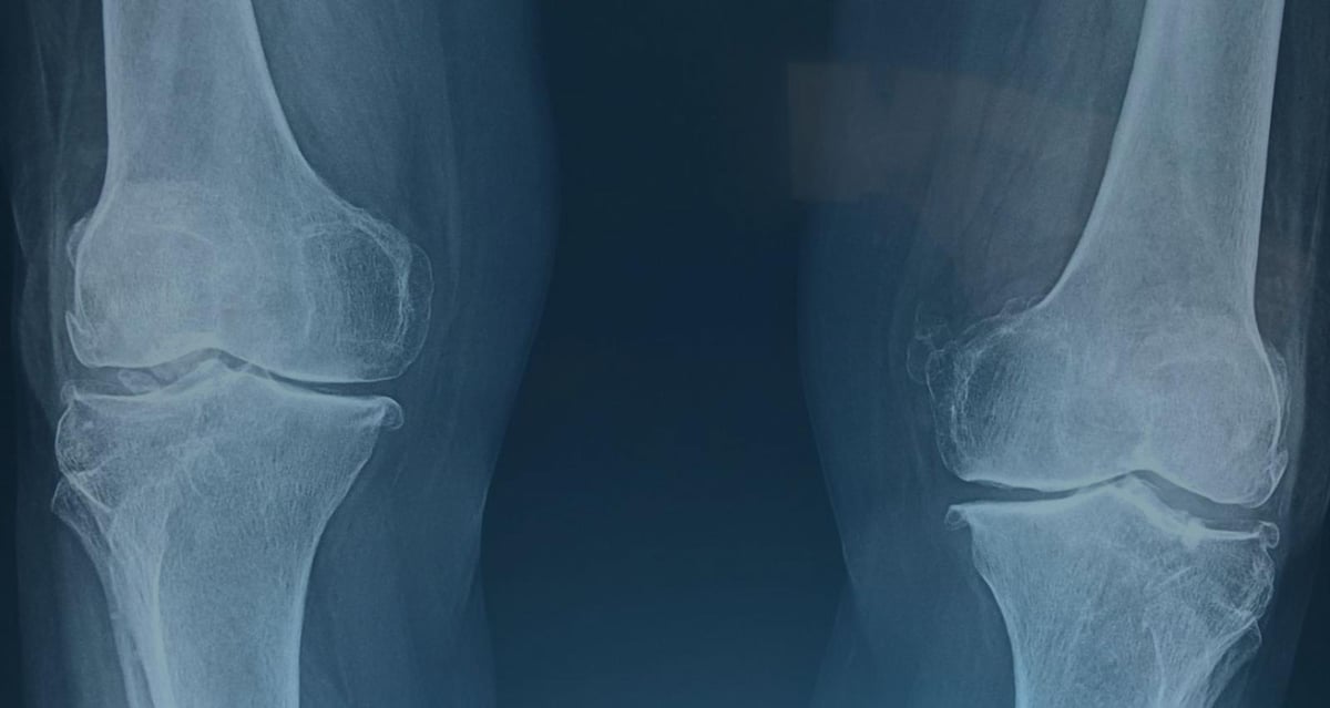 X-ray image showing knee osteoarthritis with degenerated cartilage and joint space narrowing.