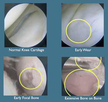 Stages of OA showing normal knee cartilage, early wear, early focal bone, and extensive bone on bone OA