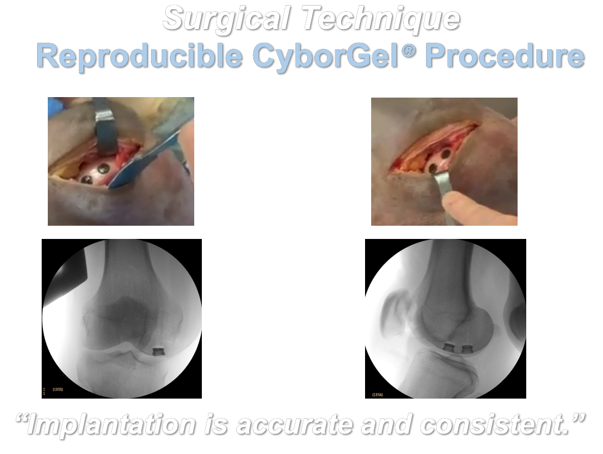 CyborGel Arthroscopic Knee Resurfacing Procedure 