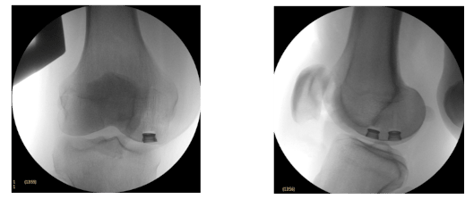 Synthetic Cartilage GelPlug Implant