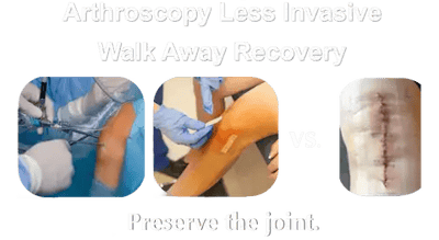 Arthroscopic Joint Resurfacing walkaway recovery for knee pain and osteoarthritis compared to Open Knee Surgery