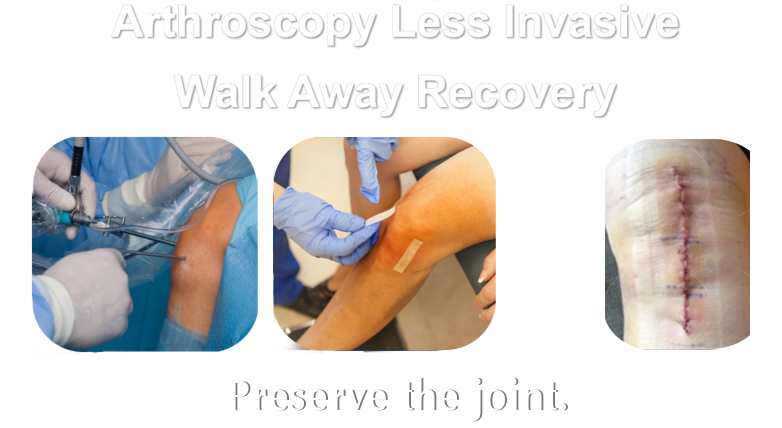 Arthroscopic Knee Resurfacing walkaway solution
