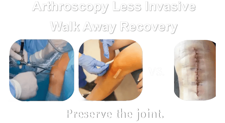 Arthroscopic Joint Resurfacing walkaway recovery for knee pain and osteoarthritis