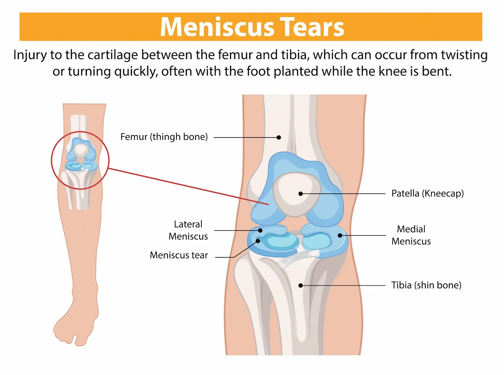 A picture of the knee showing where the meniscus is located in the knee. Illustration of meniscus tear and in image text says injury to the cartilage between the femur and tibia, which can occur from twisting or turning quickly, often with the foot planted while the knee is bent.