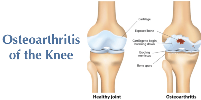 A compare and contrast diagram showing a healthy knee vs an osteoarthritic knee. Osteoarthritic Knee shows breaking down of cartilage, eroding meniscus, and bone spurs.