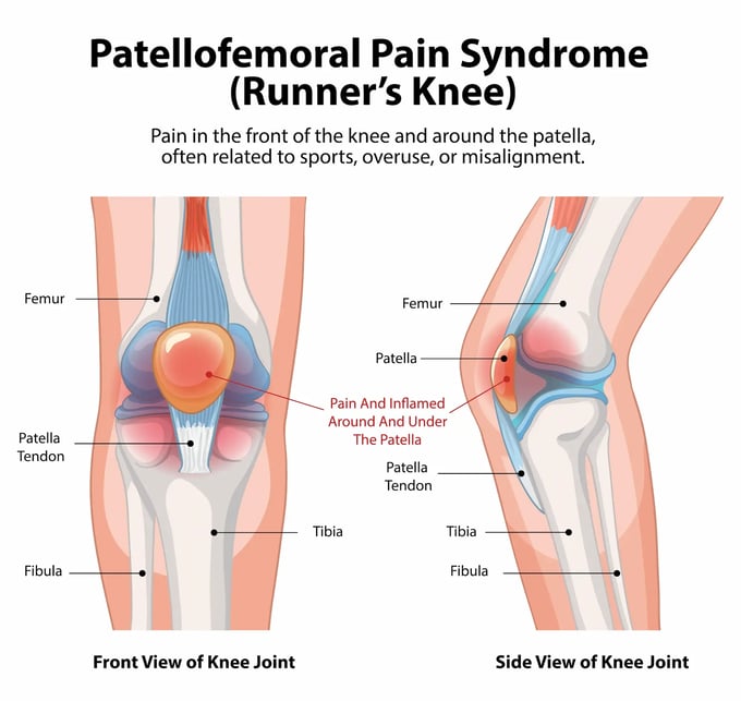 A front and side view of knee joint showing patellofemoral pain syndrome also known as Runner's Knee. Diagram shows knee bones and ligaments and shows inflamed area around and under the patella.